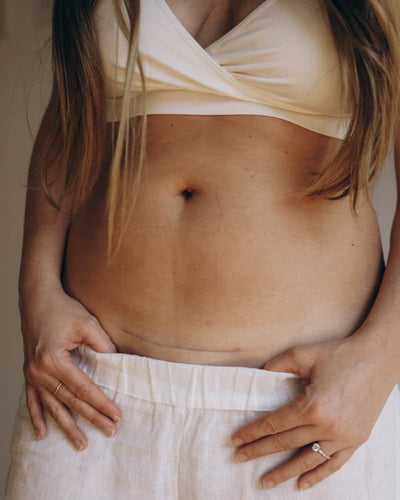 Close-up of a woman's lower abdomen showing a horizontal C-section scar above the pubic area.