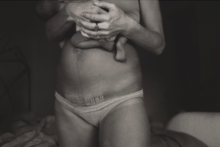 Close-up of a woman's torso with a healing scar and bandage above her underwear, holding a baby. Text on image reads 'My Scar Is My Story'.