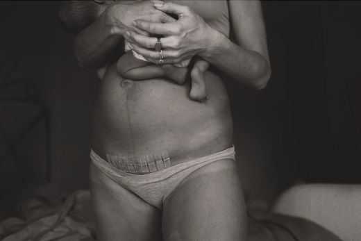 Mother holding newborn against bare torso showing healing C-section scar and bandage above underwear in dim bedroom