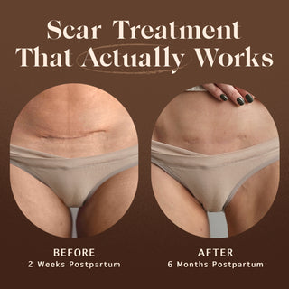 Scar Treatment That Actually Works circled word Actually, before and after photos of a postpartum scar on a woman's lower abdomen, labeled 'BEFORE 2 Weeks Postpartum' and 'AFTER 6 Months Postpartum'