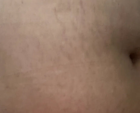 close-up picture of stretch marks on the stomach